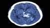 Dementia, Depression Common Following ICH Dementia, Depression Common Following ICH