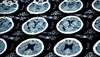 What Neuroimaging Can Teach us About Depression What Neuroimaging Can Teach us About Depression
