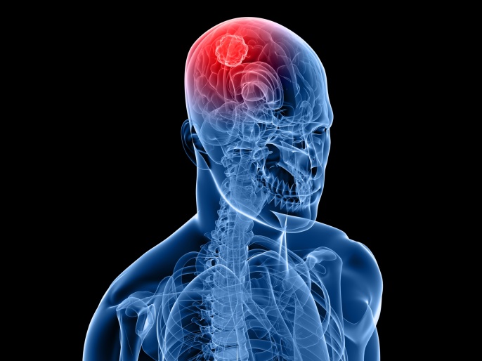 Valproic Acid Beneficial In Glioblastoma But Not Low