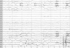 Case Study: Surgical Tx of Refractory Seizures in a Child with Hx of AVM, ICH Case Study: Surgical Tx of Refractory Seizures in a Child with Hx of AVM, ICH