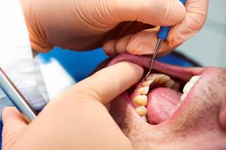 Those with the gum disease saw a 6-fold increase in cognitive decline over follow-up. Those with the gum disease saw a 6-fold increase in cognitive decline over follow-up.