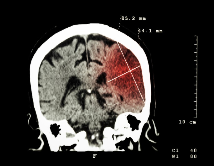 what reasons leg swelling after a stroke