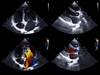 Guideline Update: Management of Recurrent Stroke With Patent Foramen Ovale Guideline Update: Management of Recurrent Stroke With Patent Foramen Ovale