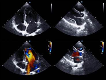 Guideline Update: Management of Recurrent Stroke With Patent Foramen Ovale Guideline Update: Management of Recurrent Stroke With Patent Foramen Ovale