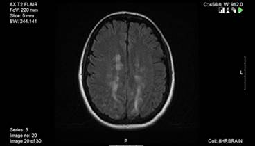 Differentiating Multiple Sclerosis Mimics on MRI Differentiating Multiple Sclerosis Mimics on MRI
