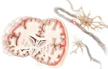 Addressing Gender Differences in Concussion Diagnosis and Treatment Addressing Gender Differences in Concussion Diagnosis and Treatment