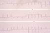 Intracranial Bleed Risk Compared for Warfarin, Apixaban in Afib Patients Intracranial Bleed Risk Compared for Warfarin, Apixaban in Afib Patients