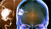Headache and Arteriovenous Malformations: Strategies for Identification, Treatment Headache and Arteriovenous Malformations: Strategies for Identification, Treatment