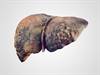Cirrhosis Associated With Increased Stroke Risk Cirrhosis Associated With Increased Stroke Risk