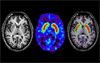 MRI in Parkinson's Disease: Expanding Usability for Better Diagnostics MRI in Parkinson's Disease: Expanding Usability for Better Diagnostics