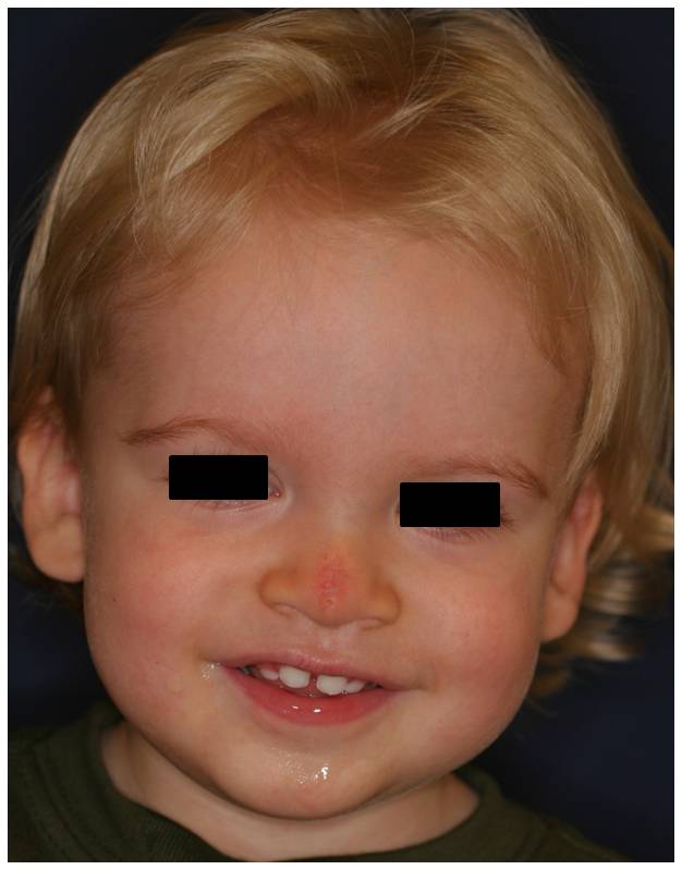 Facial Dermoid Cyst 68