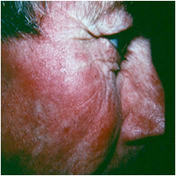 Chemical dermatitis - RightDiagnosis.com