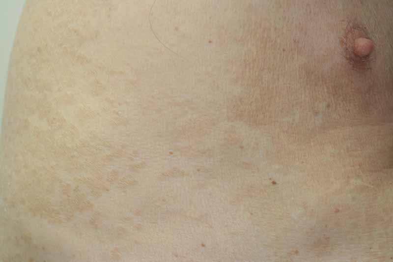 physical assessment of tinea versicolor an an Tinea versicolor is a condition characterized by a skin eruption on the trunk and proximal extremities the majority of tinea versicolor is caused by the fungus . physical assessment of tinea versicolor an an Tinea versicolor is a condition characterized by a skin eruption on the trunk and proximal extremities the majority of tinea versicolor is caused by the fungus .