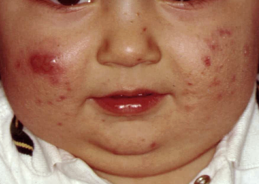 signes cliniques acné juvénile 89 signes cliniques acné juvénile 89