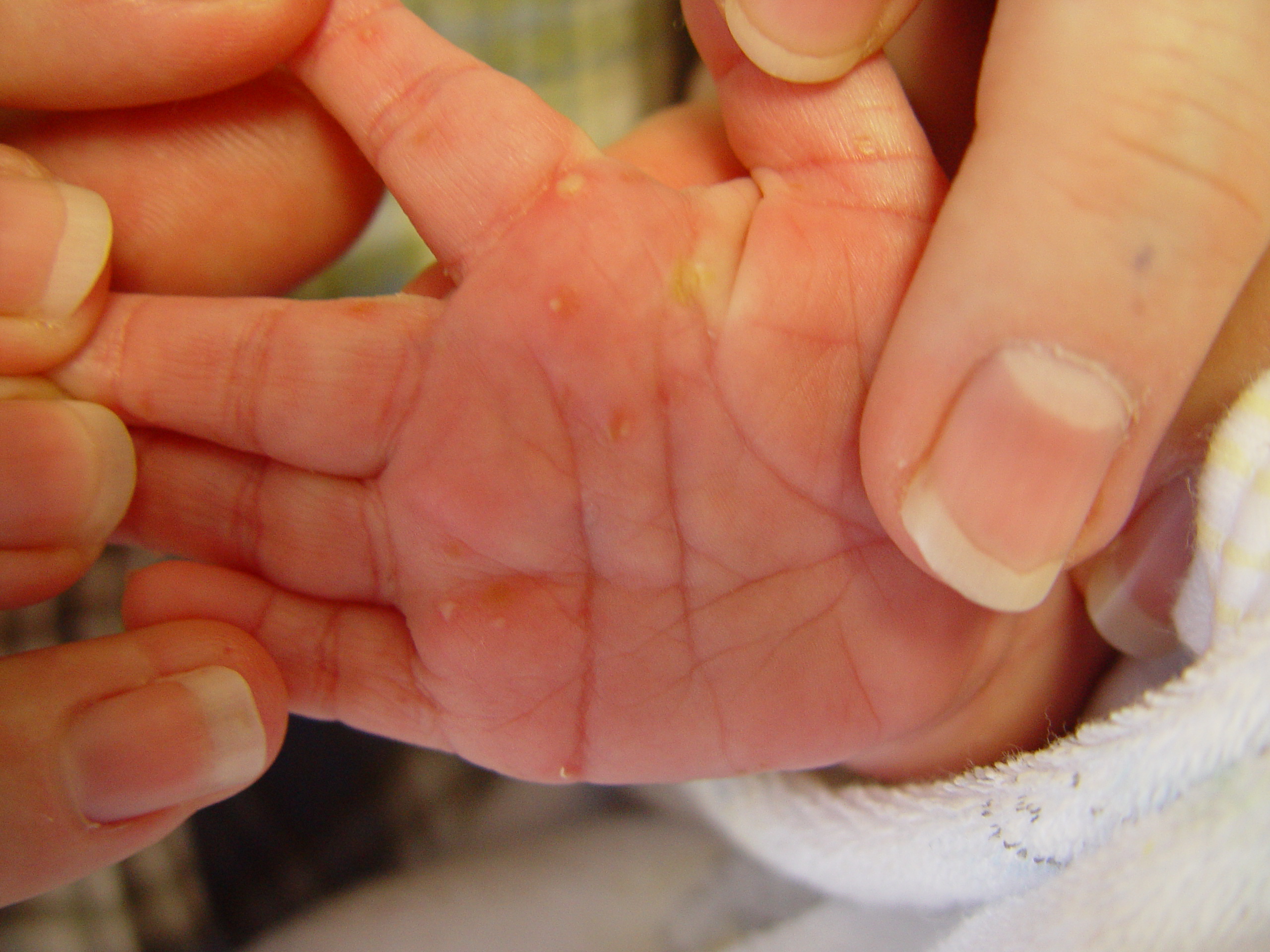 Neonatal Acne (Acne neonatal and infantile)