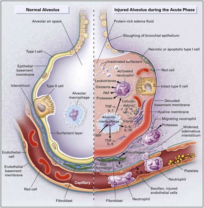 acute-respiratory-distress-syndrome-acute-hypoxemic-respiratory