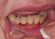 Vitamin C Deficiency Scurvy 