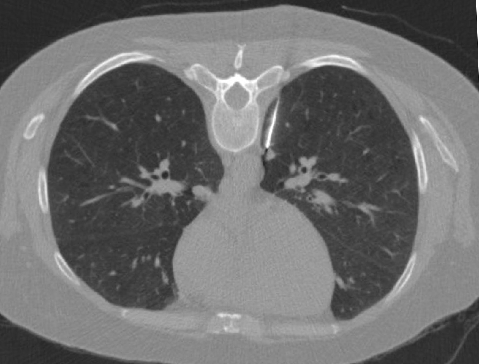 Image Guided Transthoracic Needle Biopsy