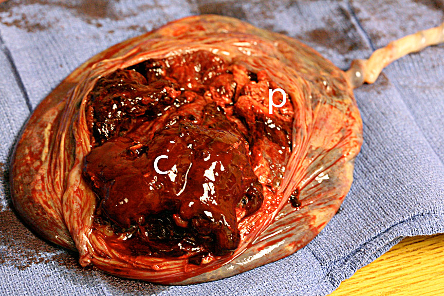 abruptio placenta Placental abruption refers to a premature separation of the normally implanted placenta after the 20th week of gestation and before the 3rd stage of labour it is a. abruptio placenta Placental abruption refers to a premature separation of the normally implanted placenta after the 20th week of gestation and before the 3rd stage of labour it is a.