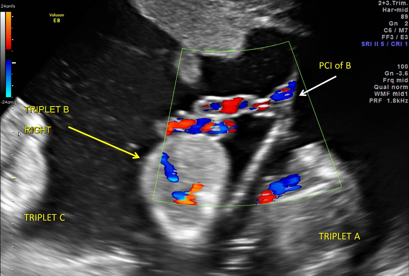 Twin-Twin Transfusion Syndrome (TTTS)