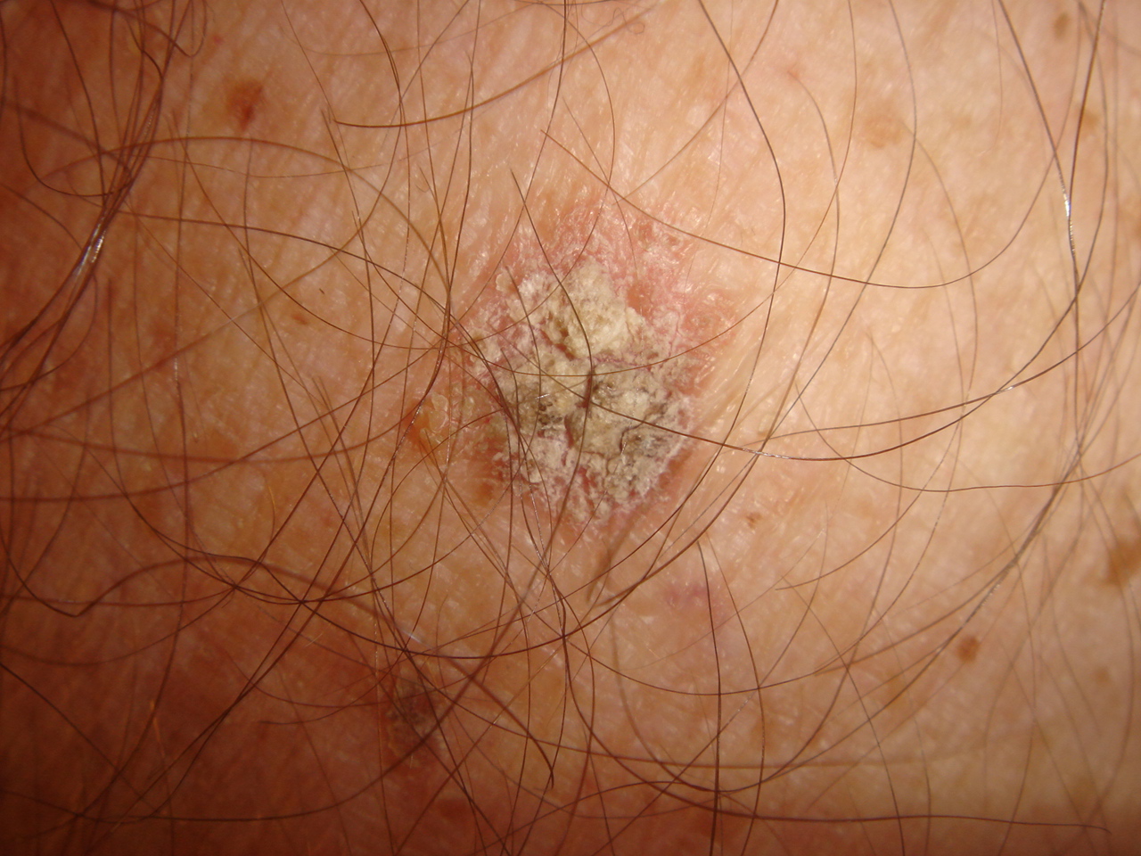 actinic-keratosis-solar-keratosis-sun-spots