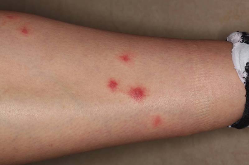 Types Of Bug Bites That Sting