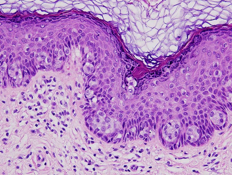 Paget's Disease of the Breast and Extramammary Paget's Disease