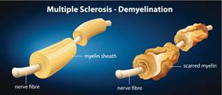 Placental Cells May Present New Treatment for MS Placental Cells May Present New Treatment for MS