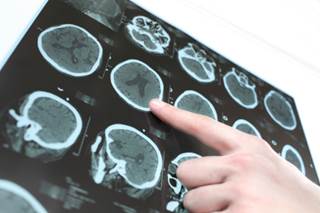 Brain Imaging Changes May Predict Cardiovascular Disease Brain Imaging Changes May Predict Cardiovascular Disease
