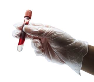 High Triglycerides Linked to Small Vessel Disease High Triglycerides Linked to Small Vessel Disease