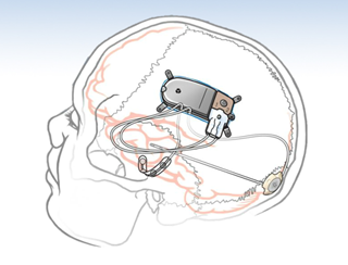 Responsive Stimulation Safe, Effective for Intractable Partial Epilepsy Responsive Stimulation Safe, Effective for Intractable Partial Epilepsy