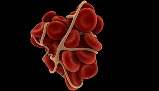 A loose blood clot in a venous thromboembolism. A loose blood clot in a venous thromboembolism.