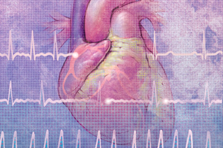 Risk for 'Silent Stroke' Doubles with Atrial Fibrillation Risk for 'Silent Stroke' Doubles with Atrial Fibrillation
