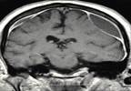 Risk of Intracranial Bleeds Higher with Warfarin than Dabigatran Risk of Intracranial Bleeds Higher with Warfarin than Dabigatran