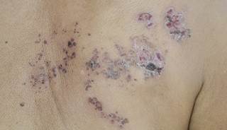 Case Report: Neurotoxicity With Acyclovir In Dialysis Patient Case Report: Neurotoxicity With Acyclovir In Dialysis Patient