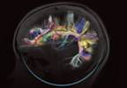 White Matter Abnormalities and Clinical Symptom Severity in Schizophrenia White Matter Abnormalities and Clinical Symptom Severity in Schizophrenia
