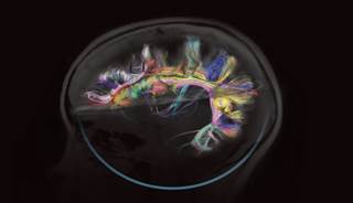 Changes in White Matter May Predict Alzheimer's Disease Type Changes in White Matter May Predict Alzheimer's Disease Type