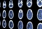 Short Sleep Duration Linked to Increased Risk for CVD and Stroke Mortality Short Sleep Duration Linked to Increased Risk for CVD and Stroke Mortality