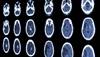 Stroke in Young Adults: Risk Factors and Prognosis Stroke in Young Adults: Risk Factors and Prognosis