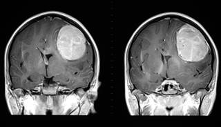 A 42-year-old man recently received gamma knife treatment for brain metastasis and a follow-up physical exam revealed some cardiovascular abnormalities. A 42-year-old man recently received gamma knife treatment for brain metastasis and a follow-up physical exam revealed some cardiovascular abnormalities.