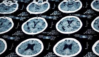 Neuroimaging furthers our understanding of how brain structure and function are altered in major depressive disorder (MDD). Neuroimaging furthers our understanding of how brain structure and function are altered in major depressive disorder (MDD).