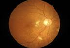 Brain Stimulation May Improve Vision in Glaucoma Brain Stimulation May Improve Vision in Glaucoma