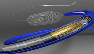 FDA Approves Pipeline Flex Diversion Device for Aneurysm FDA Approves Pipeline Flex Diversion Device for Aneurysm