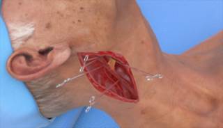 FDA Approves First-Ever Carotid Angioplasty Device for Neck Access FDA Approves First-Ever Carotid Angioplasty Device for Neck Access