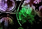 TNK-tPA Effective, Possibly Better than Alteplase for Minor Stroke TNK-tPA Effective, Possibly Better than Alteplase for Minor Stroke