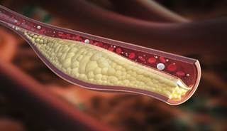Cholesterol Cholesterol