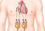 Heart Implant Linked to Decline in Cognitive Function Heart Implant Linked to Decline in Cognitive Function
