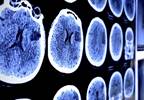 Glioma Subtypes Identified Through Genomic Alterations Glioma Subtypes Identified Through Genomic Alterations