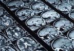 Psychotherapy Impacts Neural Circuits in Personality Disorder Psychotherapy Impacts Neural Circuits in Personality Disorder