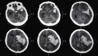 Restarting anticoagulation after both nonlobar and lobar ICH was associated with decreased mortality. Restarting anticoagulation after both nonlobar and lobar ICH was associated with decreased mortality.